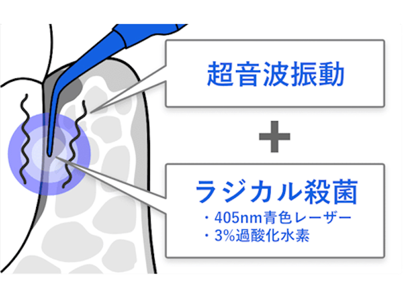 超音波振動 ラジカル殺菌 ・405nm青色レーザー ・3%過酸化水素